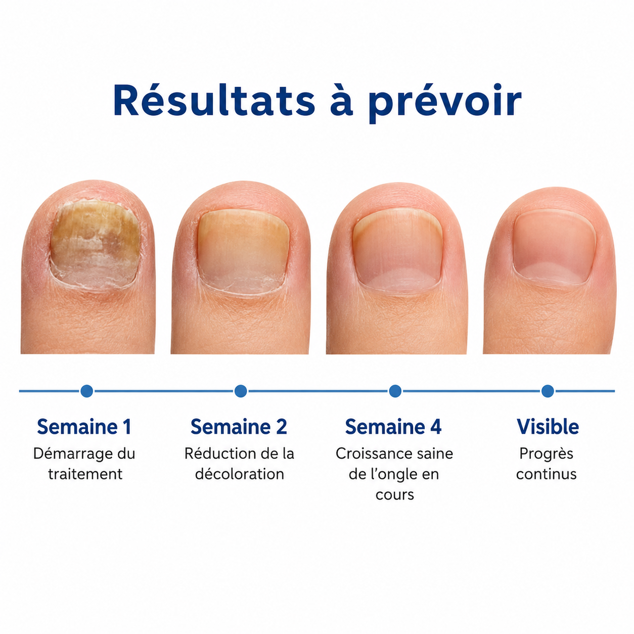 Patchs antifongiques pour ongles LERONIA™