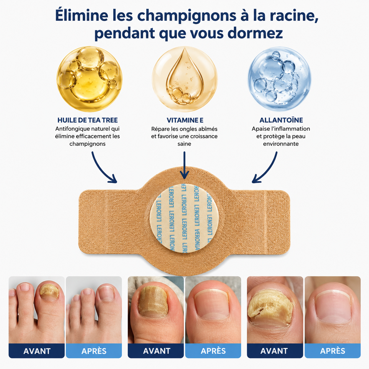 Patchs antifongiques pour ongles LERONIA™